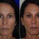 woman's face before and after Juvederm showing improved skin tone and texture