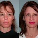 Sculptra before and after