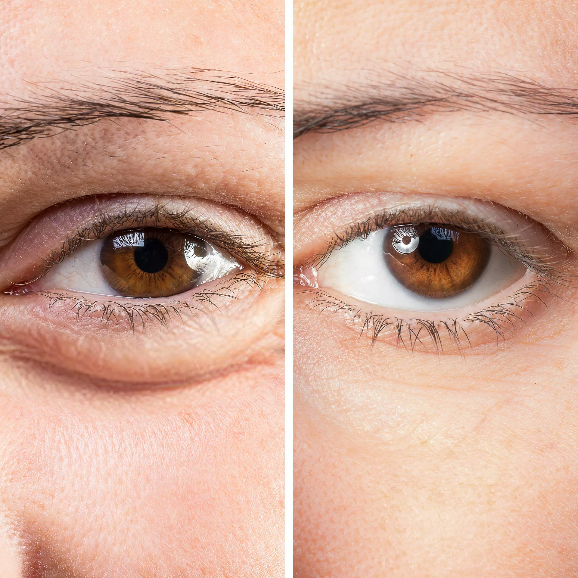 Under Eye Fillers - Before & After Results at Skinly