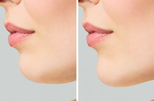 before and after chin implants