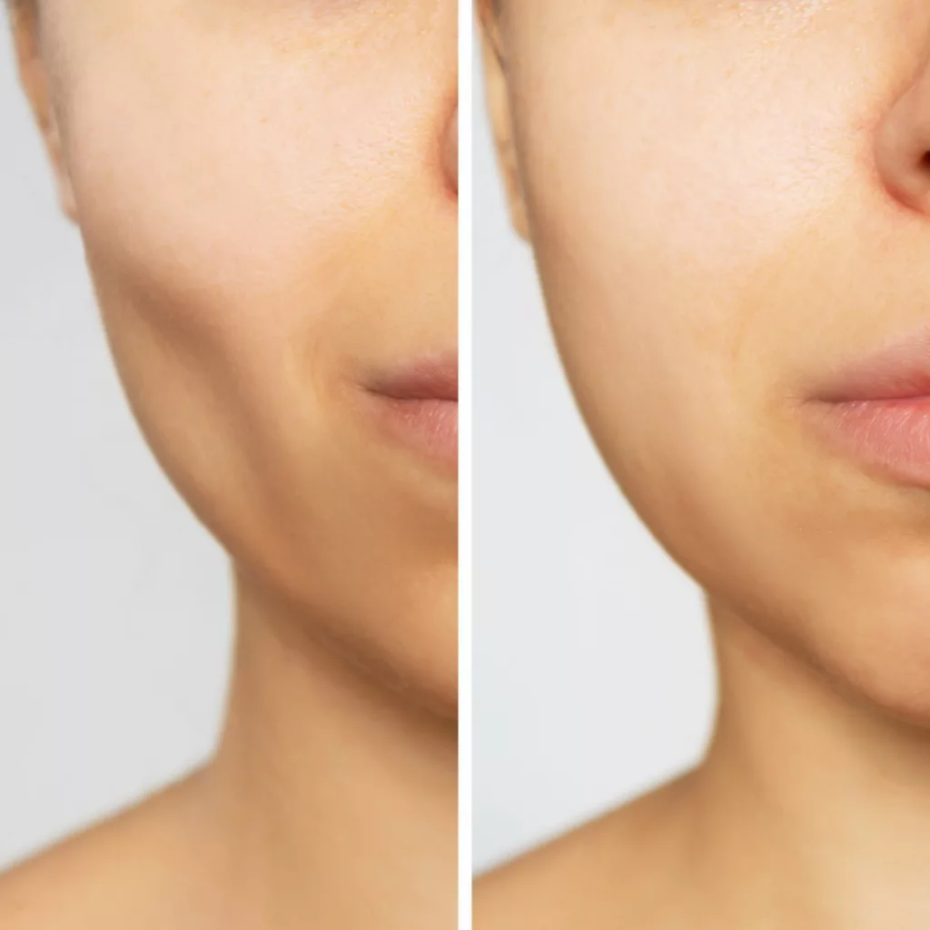 before and after juvederm voluma xc cheek fillers