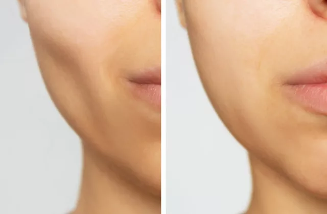 before and after juvederm voluma xc cheek fillers