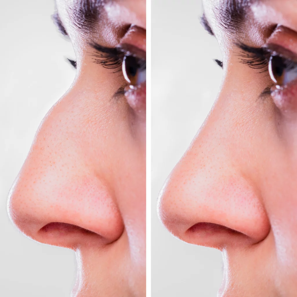 before and after nose job