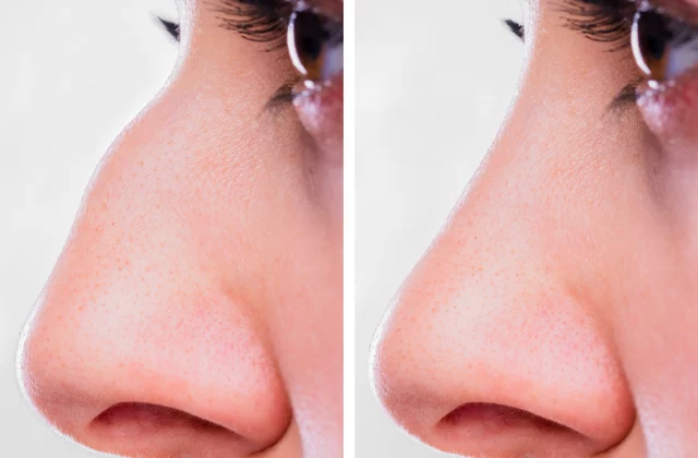 before and after nose job