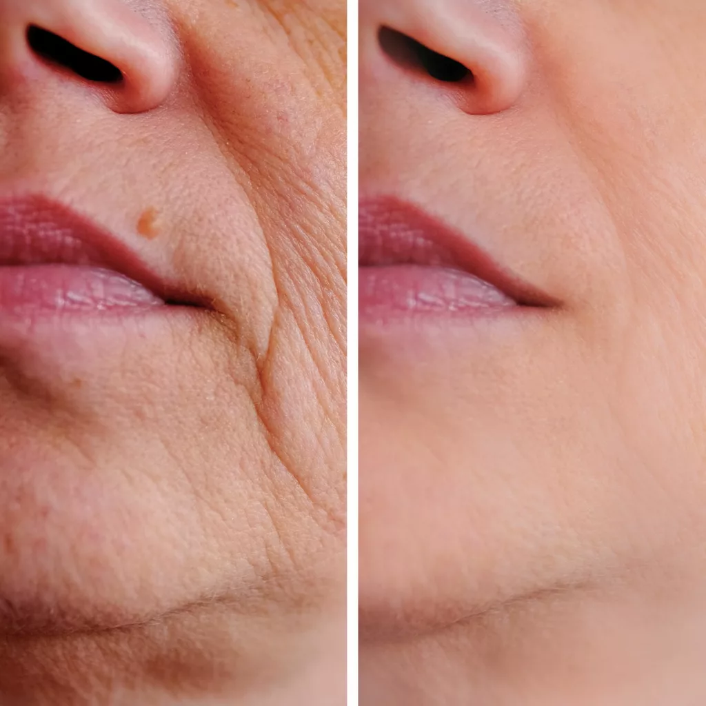 before and after restylane fillers to diminish lines around the mouth