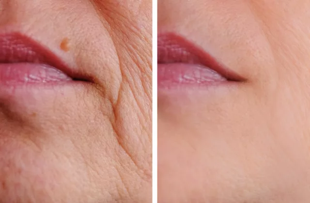 before and after restylane fillers to diminish lines around the mouth