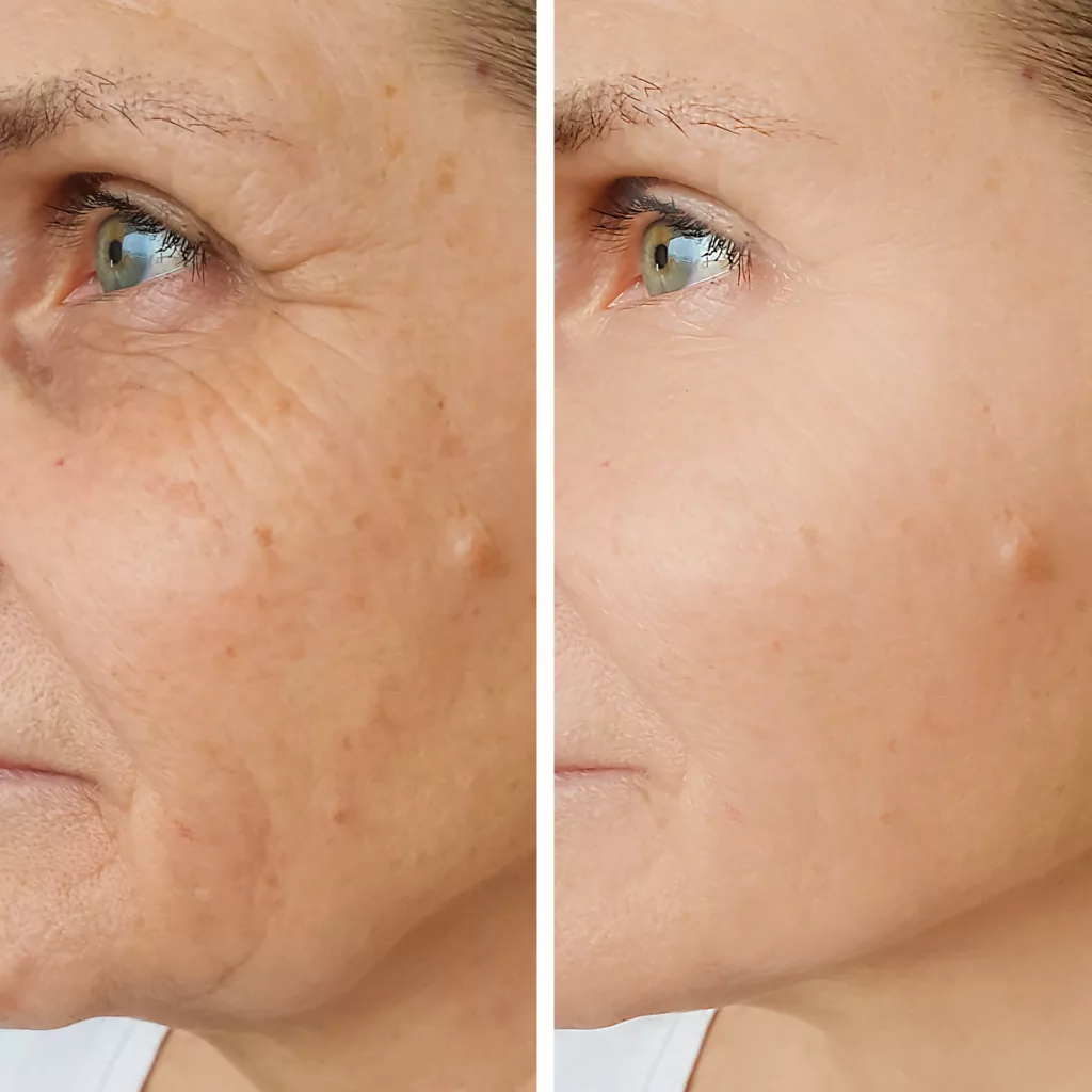 before and after sculptra aesthetic to restore lost volume and collagen