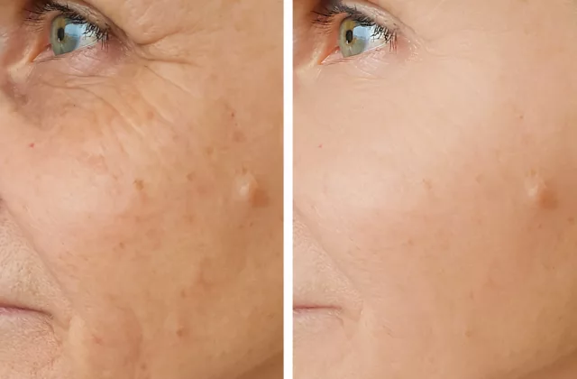 before and after sculptra aesthetic to restore lost volume and collagen