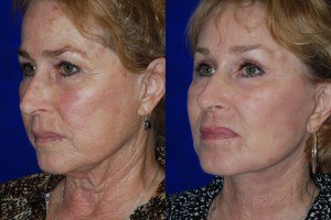 plastic surgery for facelift before and after