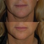 a woman's face before and after Juvederm showing improved skin tone and texture