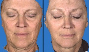 3D Image of an actual patient treated at Artemedica by Dr. Lacombe with Juvederm Voluma.