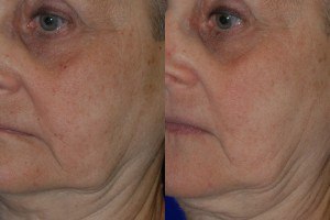 laser facial resurfacing before and after