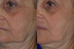 laser facial resurfacing before and after