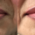 Before and after woman's injection of restylane to enhance lips