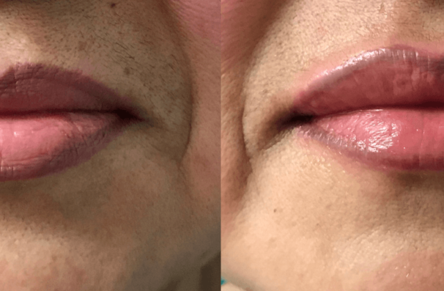 Before and after woman's injection of restylane to enhance lips