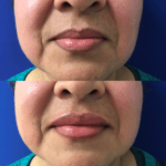 Before and after woman's injection of Juvederm to enhance lips