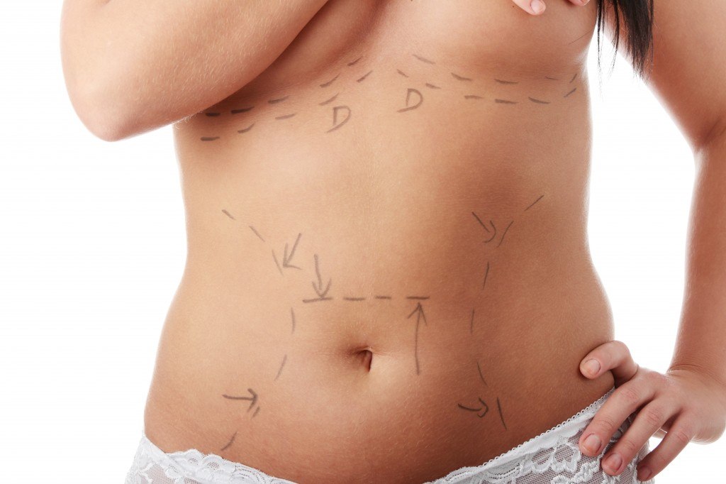 Female with Body and Breast Surgery prep drawings on her torso