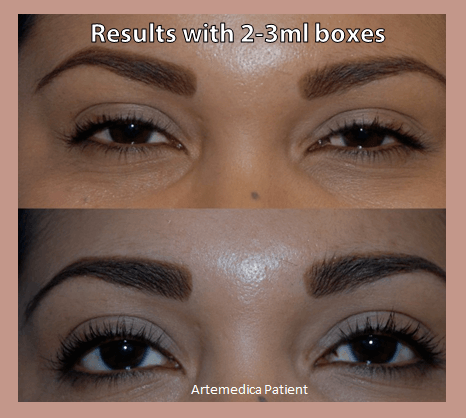 Latisse before and after Artemedica's Second 2014 Lash Flash