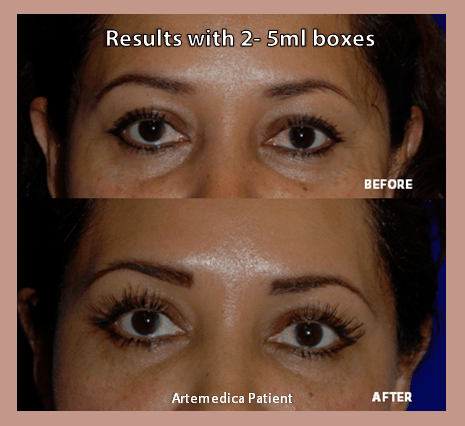 Before and after using Latisse from Artemedica's 2014 Lash Flash