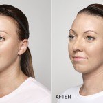 restylane silk before and after