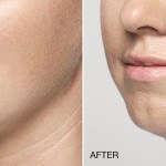 restylane silk before and after