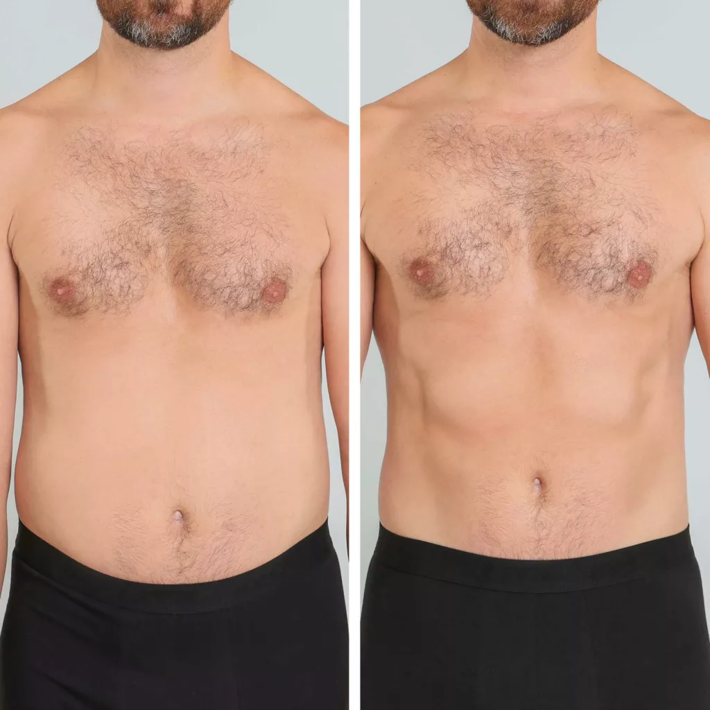 before and after liposuction in the abdomen