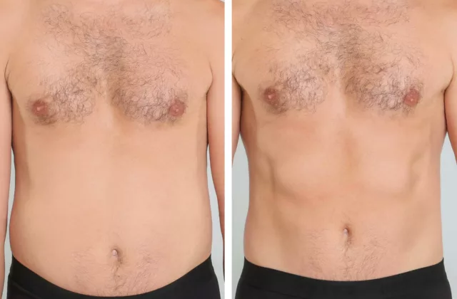before and after liposuction in the abdomen