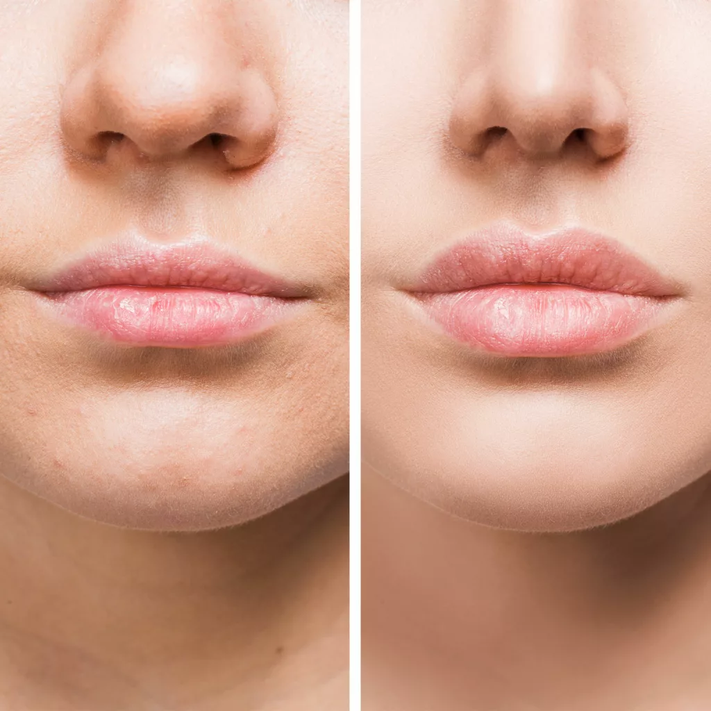 before and after restylane silk fillers to enhance lip volume and definition