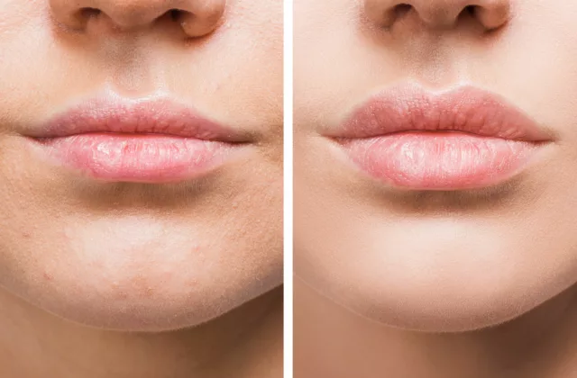 before and after restylane silk fillers to enhance lip volume and definition