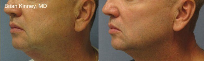 Man Before and After ThermiTight Procedure