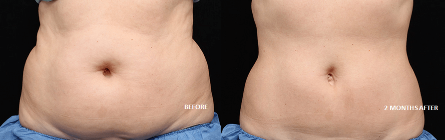 coolsculpting before and after