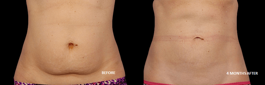 coolsculpting before and after