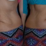 woman's abdomen before and after thermi smooth
