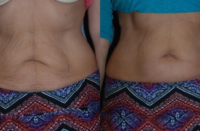 woman's abdomen before and after thermi smooth