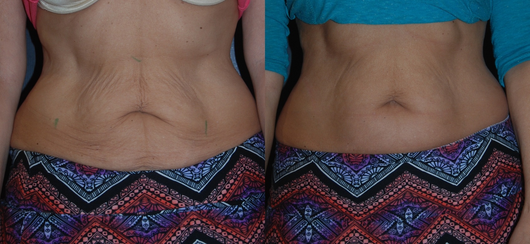woman's abdomen before and after thermi smooth