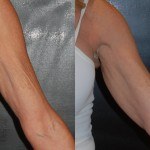 woman's upper arm before and after ThermiSmooth