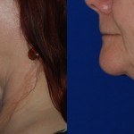 side profile of woman's lower face and neck before and after thermi smooth
