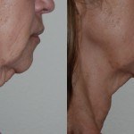 side profile of woman's lower face and neck before and after thermi smooth