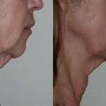 side profile of woman's lower face and neck before and after thermi smooth