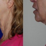 side profile of woman's face and neck before and after thermi smooth