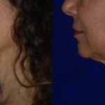 side profile of woman's face and neck before and after thermi smooth