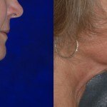 side profile of woman's lower face and neck before and after thermi smooth