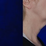 side profile of woman's lower face and neck before and after thermi smooth