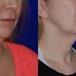 woman's lower face and neck before and after thermi smooth