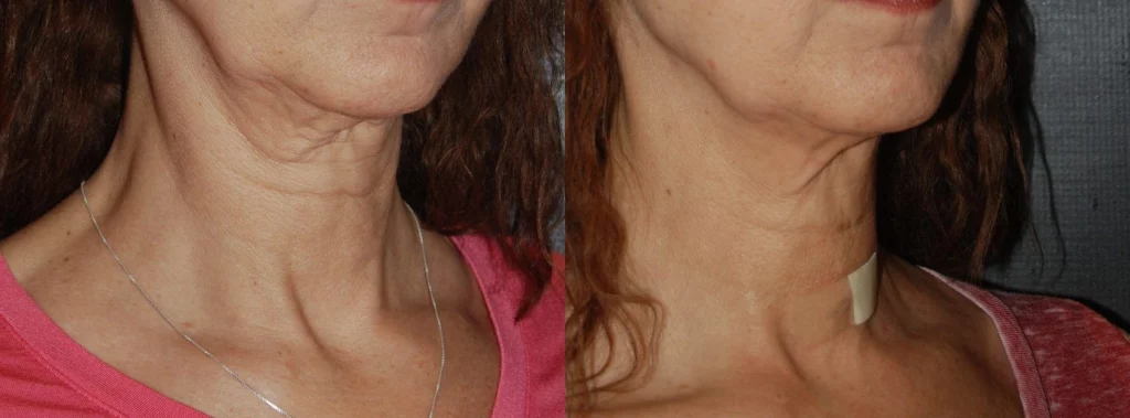 womans chest and neck before and after thermi smooth