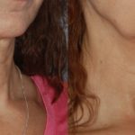 womans chest and neck before and after thermi smooth