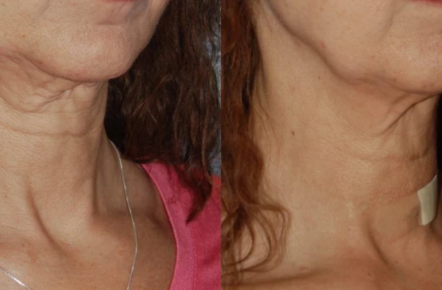 womans chest and neck before and after thermi smooth