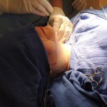 Dr. Victor Lacombe performing Thermitight cosmetic surgery procedure on client's chin and neck