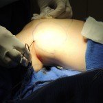 Dr. Victor Lacombe performing Thermitight cosmetic surgery procedure on client's thigh