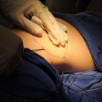 Dr. Victor Lacombe performing Thermitight cosmetic surgery procedure on client's abdomen